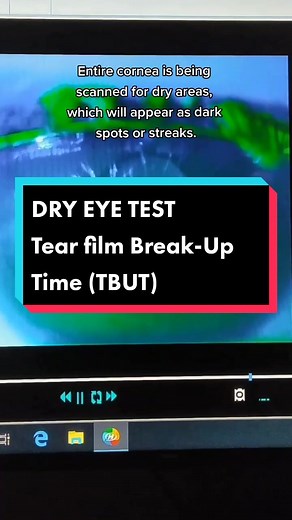 Tear film Break-Up Time is a method for determining the stability of the tear film and checking evaporative dry eye. To measure TBUT, fluorescein is instilled into the patient's tear film and the patient is asked not to blink while the tear film is observed under a broad beam of cobalt blue illumination. The TBUT is recorded as the number of seconds that elapse between the last blink and the appearance of the first dry spot in the tear film.#fyp #tiktokclinic #tiktokdoctor #optometrist #dryeye