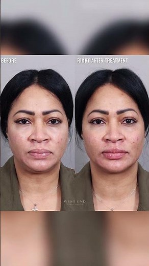✨ Facial Balancing with Rahma Scott, PA-C | West End Plastic Surgery