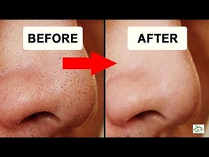 Remove blackhead on nose step by step at home with Video HD Blackhead