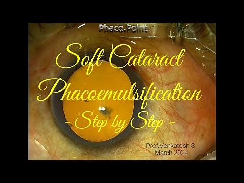 SOFT CATARACT PHACOEMULSIFICATION - STEP BY STEP - A GOOD APPROACH