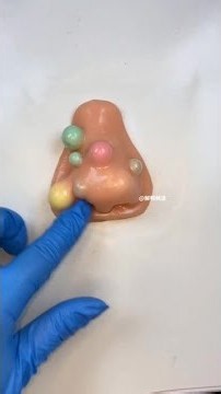 Big nose picking acne #Stress relief squeeze #OCD benefit