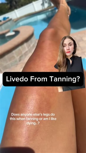 Andrea Suarez, MD PhD FAAD | Can you get livedo reticularis from tanning? #skinhealth #dermatology #dermatologist maddieee6.7 on TT | Instagram