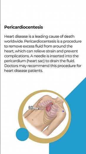 Understanding Pericardiocentesis: Procedure, Uses, and Risks Explained #cardiacintervention