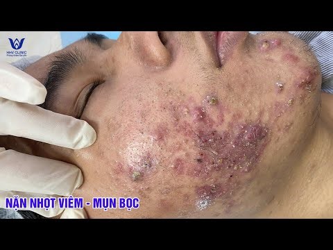 A close-up of severe inflammatory acne on the cheek: what mistakes are making the skin worse?