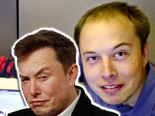 Elon Musk Hair Transplant History and Hair Analysis before and after