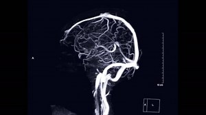 Mrv Brain Magnetic Resonance Venography Brain Mip View Turn Screen