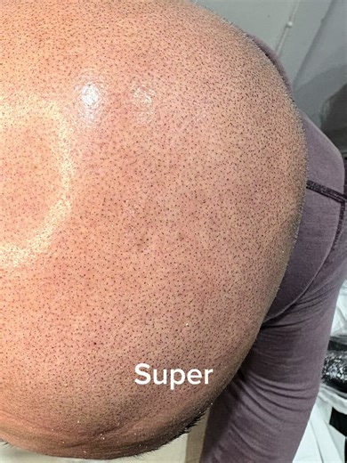 Achieve Precision in Hair Density with SMP