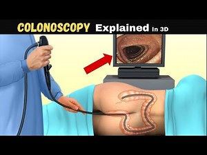 How a Colonoscopy Works –Step by Step Medical Animation #colonoscopy #colonhealth #medicalanimation