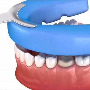 2.7M views · 5.4K reactions | Dental crown animation #Dentistry #LearningTips #BitesnBraces #smile #Pakistan #medical #People #dentista #Tooth #Dental | Bites & Braces Dental | Facebook