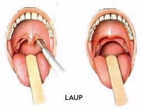 Most Common Snoring Treatment Options In West Hills, L.A., California