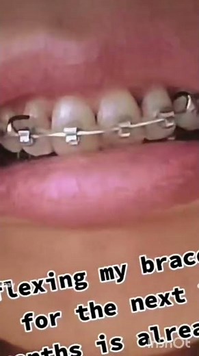 Braces Extraction before and after||watch the result #orthodontist #kieferorthopädie #germany