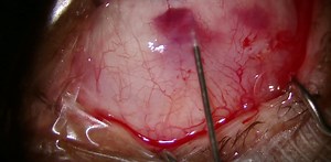 Partial Open Transconjunctival Ab Externo Xen Gel Stent Placement - Eyetube