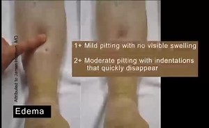 The Cardiovascular System, Part 2: Objective Data: Peripheral Pulses