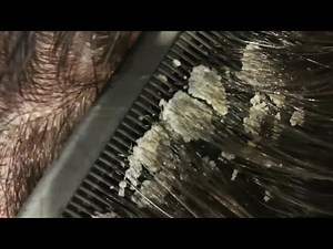 Combing Psoriasis Flakes out of oily hair
