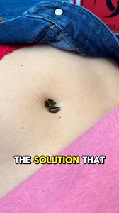 173K views · 333 reactions | Unknown growth in woman's belly button  | Sara L | Facebook
