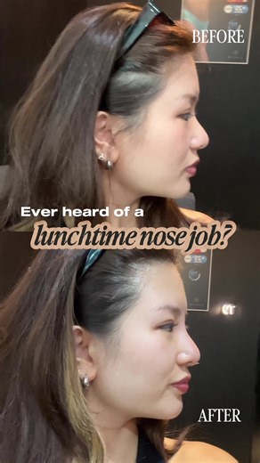 Lunchtime Nose Job: Discover the Nose Thread Lift
