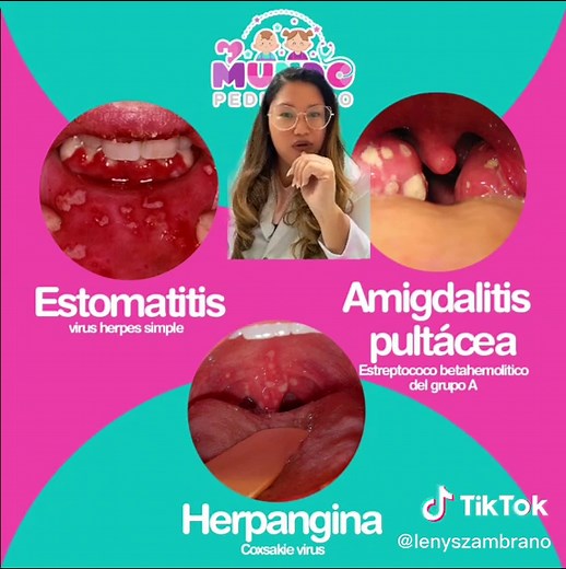Diferencias entre estomatitis herpética, herpangina y amigdalitis pultácea