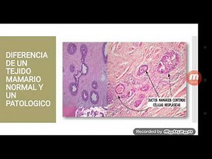 Tema N°7 Cáncer de mama invasivo o infiltrante