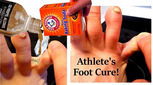 Will Hand Sanitizer Kill Athletes Foot? (14 Easy Ways) - PostureInfoHub