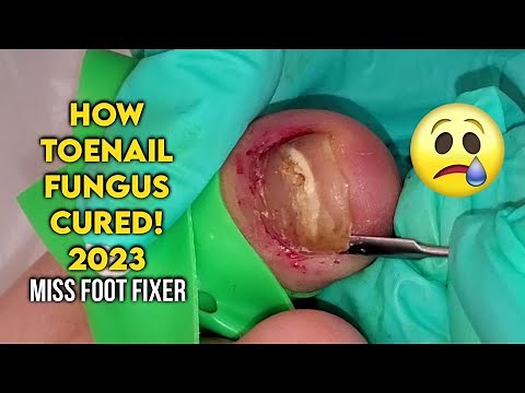HOW TOENAIL FUNGUS CURED BY REMOVING FUNGAL NAIL FULL PROCEDURE BY FAMOUS PODIATRIST MISS FOOT FIXER