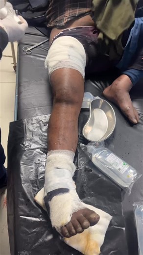 Dr Harsh Sharma on Instagram: "Compartment syndrome is a condition in which increased pressure within a closed muscle compartment compromises circulation and nerve function, leading to ischemia and tissue damage. It is a surgical emergency in acute cases. 📚 Types Acute Compartment Syndrome (ACS) Usually after trauma Emergency → requires fasciotomy Chronic (Exertional) Compartment Syndrome Seen in athletes Pain during exercise, relieved by rest ⚡ Common Causes (Especially for Exams) Fractures (m