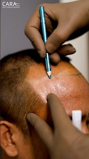 How Doctors Mark the Perfect Hairline #hairtransplant #transformation