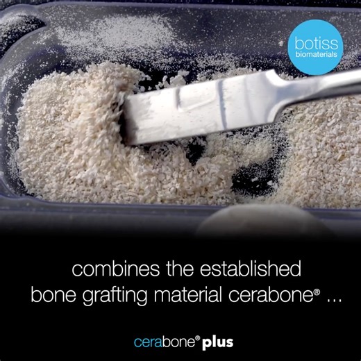 Sadent SA on Instagram: "Cerabone ® plus – Συνδυασμός cerabone και υαλουρονικού οξέος Εύπλαστο οστικό μόσχευμα που επιτρέπει την εύκολη μεταφορά και διαχείρισή του στο χειρουργικό πεδίο. Για περισσότερες πληροφορίες/παραγγελίες καλέστε μας στο 6937 274231 ή στείλτε μας email στο emaretsos@gmail.com www.sadent.com/cerabone-plus #sadentsa #botiss #ceraboneplus #HyaluronicAcid #hya #stickybone #implantology #drivingdentalinnovation #dentalsurgery #bonegrafting #dentistry #οδοντίατρος #οδοντιατρική"