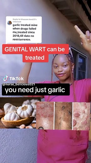 How to Use Garlic for Effective Wart Treatment