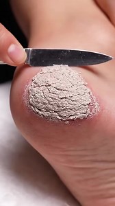 Extreme Foot Cleaning ASMR | Callus Transformation Z1BK ##footcare #heeleexfoliation #pedicure #oddlysatisfying #dryskinremoval Enjoy clean, relaxing foot-care ASMR with gentle heel exfoliation and natural callus removal. Disclaimer: AI-generated educational & relaxation content. | Viral video 427