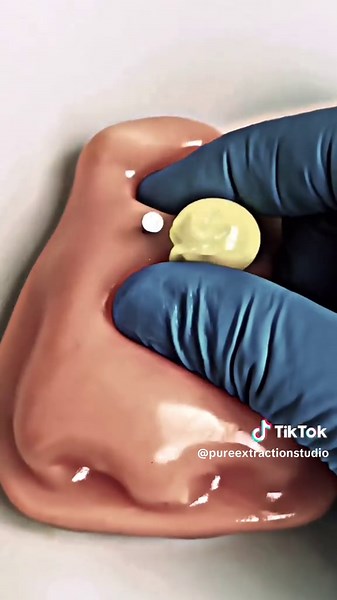 Blackhead Removal So Real You Can Feel It 😌 #BlackheadASMR #DeepClean #PimplePopping #ASMRVideo #PureSatisfaction