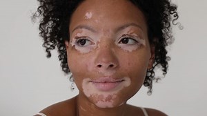 Living with Vitiligo