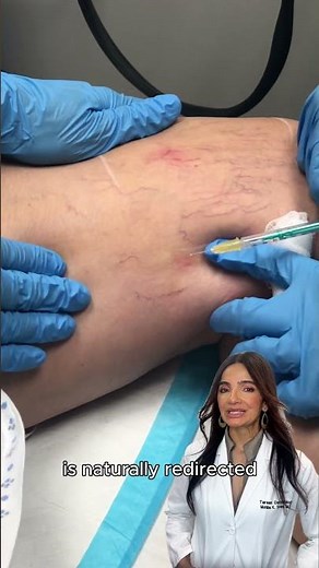 Spider veins bothering you? Sclerotherapy may help.