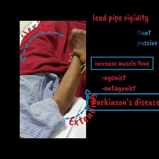 Lead-pipe rigidity | Parkinson's disease