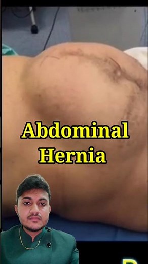 abdomina hernia #hernia