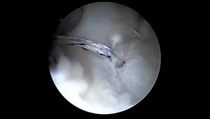 Posterior Labral Repair (All Knotless)