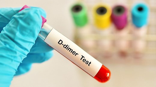D-dimères : à quoi sert ce dosage sanguin ?
