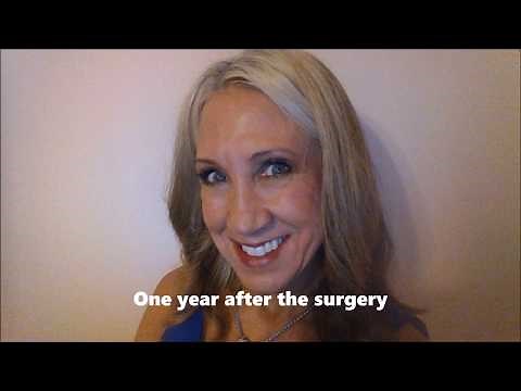MOHS Surgery on My Nose | May 2013 | Part One 😎😎😎