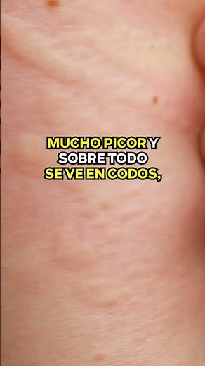 Dermatitis Herpetiforme🚨Un Indicador de Enfermedad Celíaca 🚨 Aida Almonacil