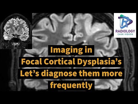 Imaging in focal cortical dysplasia's:Let's diagnose them confidently#Transmantle sign#Epilepsy MRI#