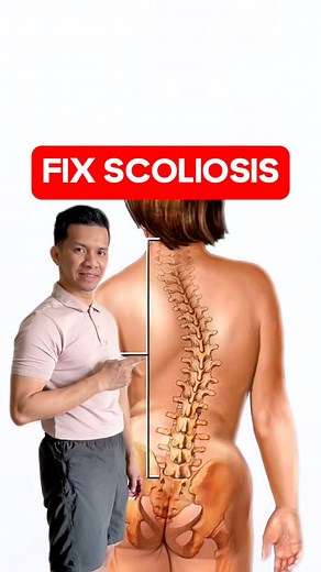 Functional scoliosis refers to a curvature of the spine that occurs due to various factors affecting muscle imbalances, posture, or leg length discrepancy. It differs from structural scoliosis, which involves a fixed curvature of the spine due to abnormal spinal development.Functional scoliosis can be acquired through habits or conditions that cause muscular imbalances, such as poor posture, unequal muscle strength, or even carrying heavy backpacks on one side consistently. Leg length discrepanc