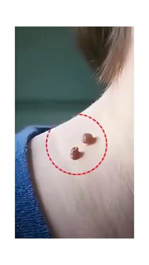 1.5K reactions · 65 shares | ⏳ Skin Tags ka Asaan Hal!  Smooth aur clear skin: Derma Smooth Skin Tag Removal Patches ke sath — bina dard, bina laser! ✨ ✅ Skin ke liye safe aur gentle ✅ Jaldi aur visible results ✅ Ghar baithe easy use  Free Cash On Delivery All over Pakistan | Pak Deal | Facebook