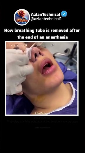 How Doctors Remove Your Breathing Tube After Anesthesia | Extubation #process #science #medtech