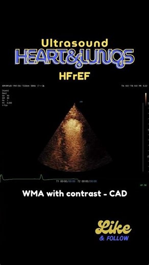 #WMA in #echocardiography - with #contrast in #ceus