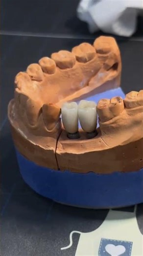 Implant screws all dental software istall end support