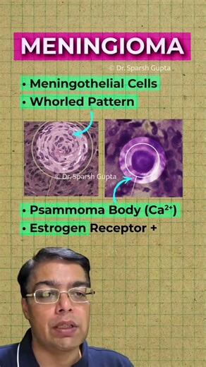 Meningioma in One Minute: Dural Mass + Seizures Explained | Dr. Sparsh Gupta