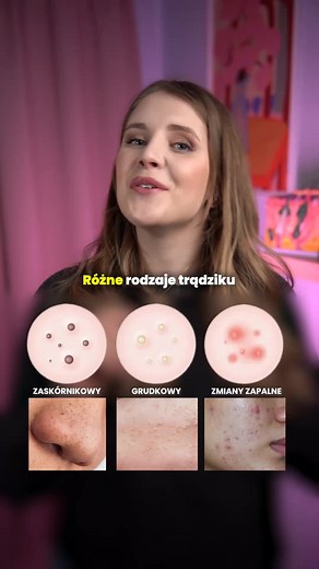 Rodzaje trądziku i skuteczne metody walki