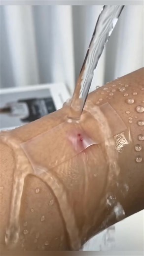 Heal Acne Scars with Breathable Second Skin Patch