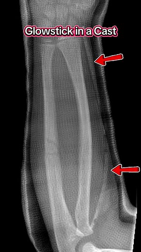 Do Not Put Glowsticks in a Cast: Pediatric Orthopedics