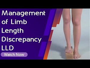 Management of Limb Length Discrepancy LLD | Orthopaedic Academy