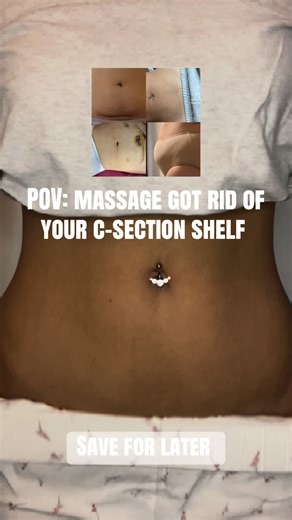 Effective C-Section Scar Massage Techniques